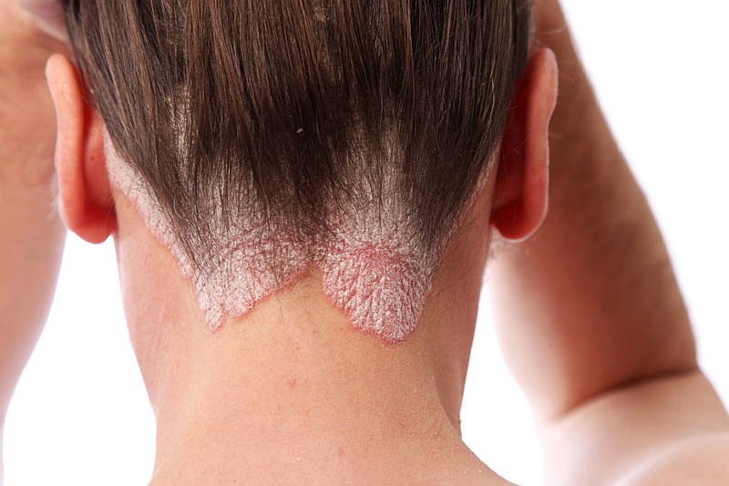 Tinea Capitis - Cured with DUlcien Whitfield Ointment Cream
